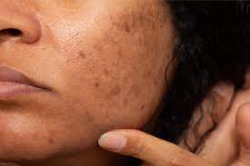 Inflammation