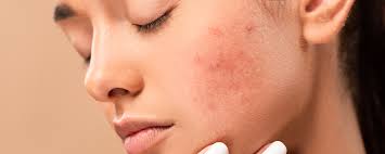 Acne Marks