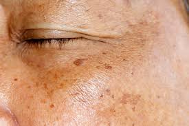 Age Spots