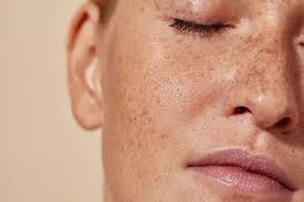 Freckles